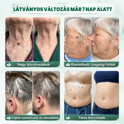 🌿𝐏𝐮𝐫𝐚𝐂𝐮𝐫𝐞® 𝐌𝐈𝐊𝐑𝐎𝐓Ű𝐒 𝐁Ő𝐑𝐊𝐈𝐍Ö𝐕É𝐒-𝐄𝐋𝐓Á𝐕𝐎𝐋Í𝐓Ó 𝐓𝐀𝐏𝐀𝐒𝐙𝐎𝐊 —𝟕 𝐍𝐀𝐏𝐎𝐒 𝐂É𝐋𝐙𝐎𝐓𝐓 𝐄𝐋𝐓Á𝐕𝐎𝐋Í𝐓Á𝐒 𝐁Ő𝐑𝐍𝐘Ú𝐋𝐕Á𝐍𝐘𝐎𝐊, 𝐒𝐙𝐄𝐌Ö𝐋𝐂𝐒Ö𝐊 É𝐒 𝐊𝐈𝐄𝐌𝐄𝐋𝐊𝐄𝐃Ő 𝐁Ő𝐑𝐇𝐈𝐁Á𝐊 𝐄𝐋𝐋𝐄𝐍
