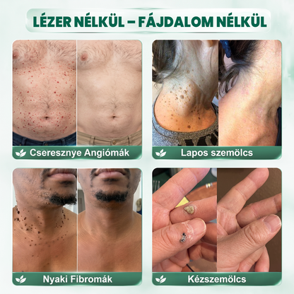 🌿𝐏𝐮𝐫𝐚𝐂𝐮𝐫𝐞® 𝐌𝐈𝐊𝐑𝐎𝐓Ű𝐒 𝐁Ő𝐑𝐊𝐈𝐍Ö𝐕É𝐒-𝐄𝐋𝐓Á𝐕𝐎𝐋Í𝐓Ó 𝐓𝐀𝐏𝐀𝐒𝐙𝐎𝐊 —𝟕 𝐍𝐀𝐏𝐎𝐒 𝐂É𝐋𝐙𝐎𝐓𝐓 𝐄𝐋𝐓Á𝐕𝐎𝐋Í𝐓Á𝐒 𝐁Ő𝐑𝐍𝐘Ú𝐋𝐕Á𝐍𝐘𝐎𝐊, 𝐒𝐙𝐄𝐌Ö𝐋𝐂𝐒Ö𝐊 É𝐒 𝐊𝐈𝐄𝐌𝐄𝐋𝐊𝐄𝐃Ő 𝐁Ő𝐑𝐇𝐈𝐁Á𝐊 𝐄𝐋𝐋𝐄𝐍