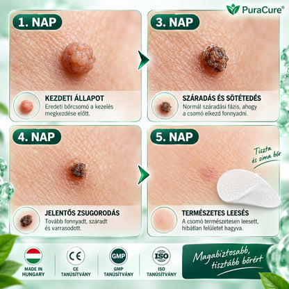 🌿𝐏𝐮𝐫𝐚𝐂𝐮𝐫𝐞® 𝐌𝐈𝐊𝐑𝐎𝐓Ű𝐒 𝐁Ő𝐑𝐊𝐈𝐍Ö𝐕É𝐒-𝐄𝐋𝐓Á𝐕𝐎𝐋Í𝐓Ó 𝐓𝐀𝐏𝐀𝐒𝐙𝐎𝐊 —𝟕 𝐍𝐀𝐏𝐎𝐒 𝐂É𝐋𝐙𝐎𝐓𝐓 𝐄𝐋𝐓Á𝐕𝐎𝐋Í𝐓Á𝐒 𝐁Ő𝐑𝐍𝐘Ú𝐋𝐕Á𝐍𝐘𝐎𝐊, 𝐒𝐙𝐄𝐌Ö𝐋𝐂𝐒Ö𝐊 É𝐒 𝐊𝐈𝐄𝐌𝐄𝐋𝐊𝐄𝐃Ő 𝐁Ő𝐑𝐇𝐈𝐁Á𝐊 𝐄𝐋𝐋𝐄𝐍