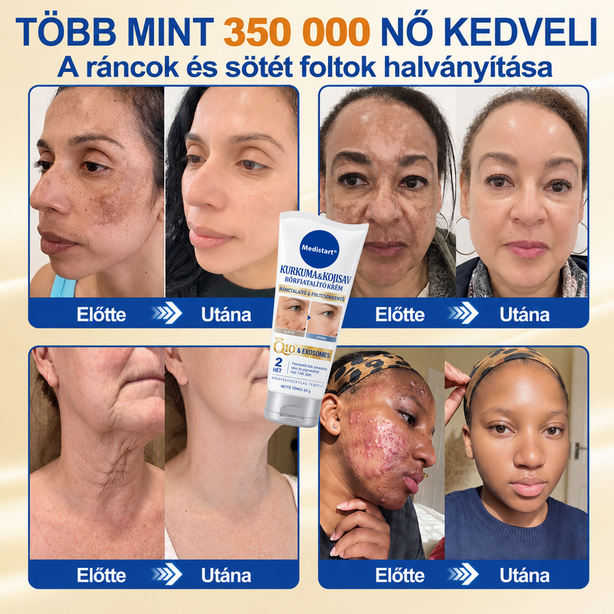 𝑯𝒊𝒗𝒂𝒕𝒂𝒍𝒐𝒔 𝑼̈𝒛𝒍𝒆𝒕 | 𝐔́𝐣! ✨ Medistart® 𝐊𝐮𝐫𝐤𝐮𝐦𝐚 × 𝐊𝐨𝐣𝐢𝐧𝐬𝐚𝐯 𝐄́𝐣𝐬𝐳𝐚𝐤𝐚𝐢 Bőrfiatalító 𝐊𝐫𝐞́𝐦— 𝐇𝐚𝐥𝐯𝐚́𝐧𝐲𝐢́𝐭𝐬𝐝 𝐚 𝐦𝐚𝐤𝐚𝐜𝐬 𝐬𝐨̈𝐭𝐞́𝐭 𝐟𝐨𝐥𝐭𝐨𝐤𝐚𝐭 𝐞́𝐬 𝐬𝐢𝐦𝐢́𝐭𝐬𝐝 𝐤𝐢 𝐚 𝐥𝐚́𝐭𝐡𝐚𝐭𝐨́ 𝐫𝐚́𝐧𝐜𝐨𝐤𝐚𝐭 𝐚𝐥𝐯𝐚́𝐬 𝐤𝐨̈𝐳𝐛𝐞𝐧 🌙 ✅ 𝐄́𝐣𝐬𝐳𝐚𝐤𝐚́𝐧𝐤𝐞́𝐧𝐭 𝐞𝐠𝐲 𝐥𝐞́𝐩𝐞́𝐬 · 𝐋𝐚́𝐭𝐡𝐚𝐭𝐨́ 𝐯𝐚́𝐥𝐭𝐨𝐳𝐚́𝐬 𝟕 𝐞́𝐣𝐬𝐳𝐚𝐤𝐚 𝐚𝐥𝐚𝐭𝐭 💯