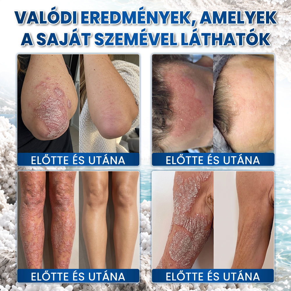 💧💧Medistart® Speciális Bőrápoló Krém Pikkelysömörös Bőrre - ✅Dermatológiailag tesztelt