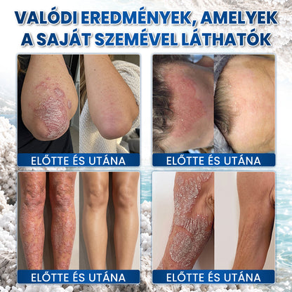 💧💧Medistart® Speciális Bőrápoló Krém Pikkelysömörös Bőrre - ✅Dermatológiailag tesztelt
