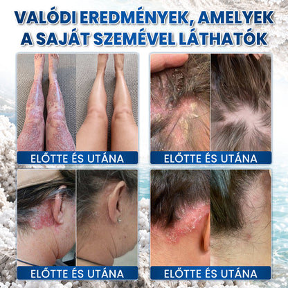 💧💧Medistart® Speciális Bőrápoló Krém Pikkelysömörös Bőrre - ✅Dermatológiailag tesztelt