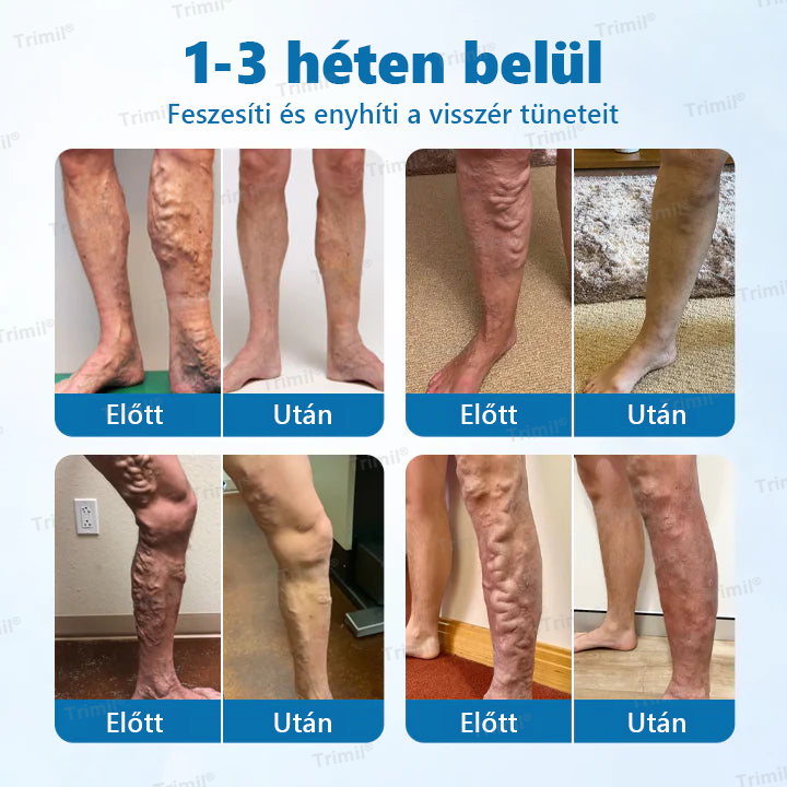 💙Trimil® VeinGuard Gyógynövényes Spray-✅ Klinikailag bizonyított, hogy mindössze 7 nap alatt megszünteti a visszereket!