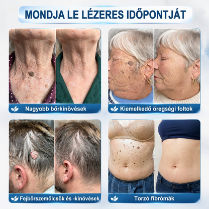 🌷𝐏𝐮𝐫𝐚𝐂𝐮𝐫𝐞® 𝐌𝐈𝐊𝐑𝐎𝐓Ű𝐒 𝐁Ő𝐑𝐊𝐈𝐍Ö𝐕É𝐒-𝐄𝐋𝐓Á𝐕𝐎𝐋Í𝐓Ó 𝐓𝐀𝐏𝐀𝐒𝐙𝐎𝐊 - ✅𝟕 𝐍𝐀𝐏𝐎𝐒 𝐂É𝐋𝐙𝐎𝐓𝐓 𝐄𝐋𝐓Á𝐕𝐎𝐋Í𝐓Á𝐒 𝐁Ő𝐑𝐍𝐘Ú𝐋𝐕Á𝐍𝐘𝐎𝐊, 𝐒𝐙𝐄𝐌Ö𝐋𝐂𝐒Ö𝐊 É𝐒 𝐊𝐈𝐄𝐌𝐄𝐋𝐊𝐄𝐃Ő 𝐁Ő𝐑𝐇𝐈𝐁Á𝐊 𝐄𝐋𝐋𝐄𝐍