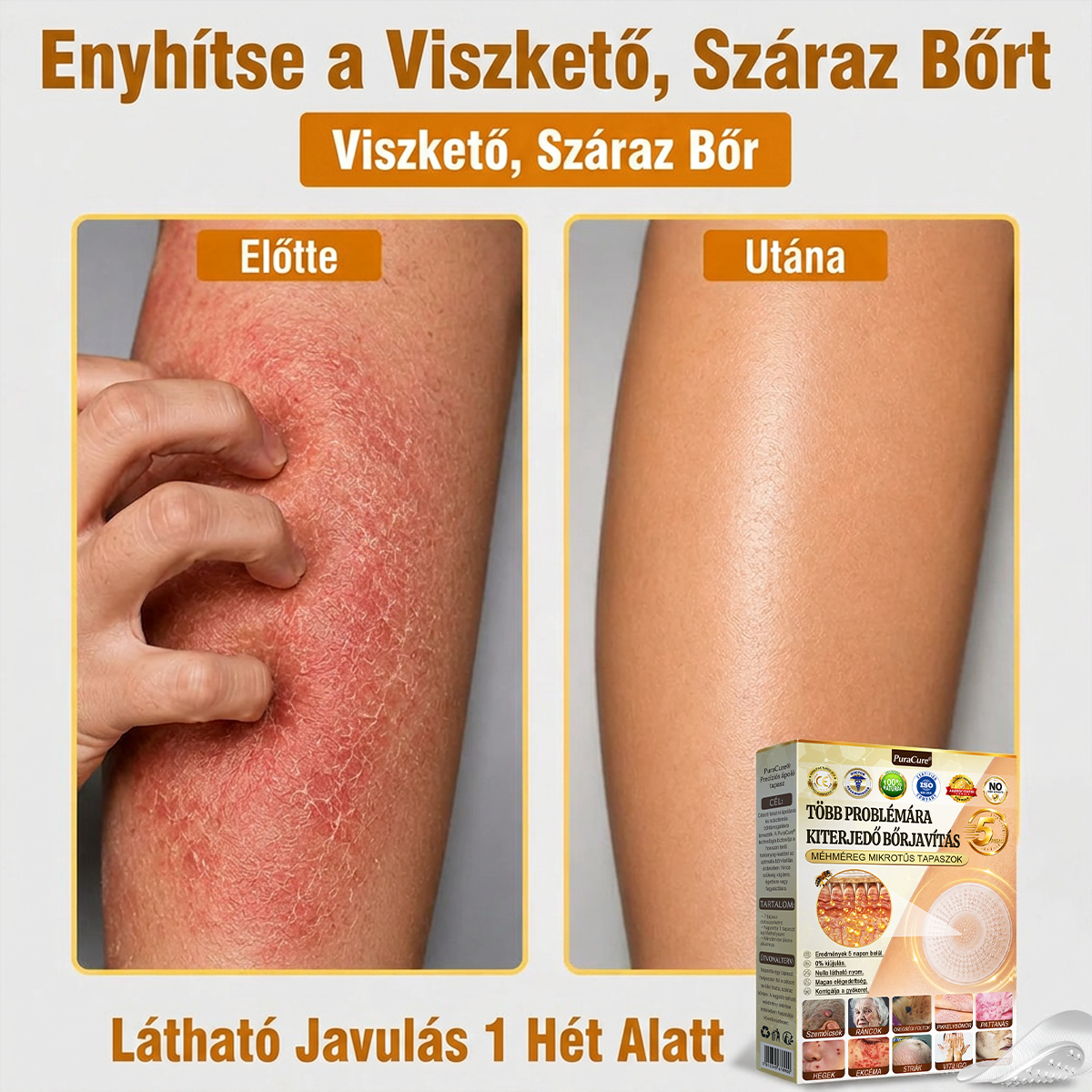 🐝PuraCure® TÖBBFÉLE BŐRPROBLÉMÁRA HATÓ MÉHMÉREG MIKROTŰS BŐRREGENERÁLÓ TAPASZOK