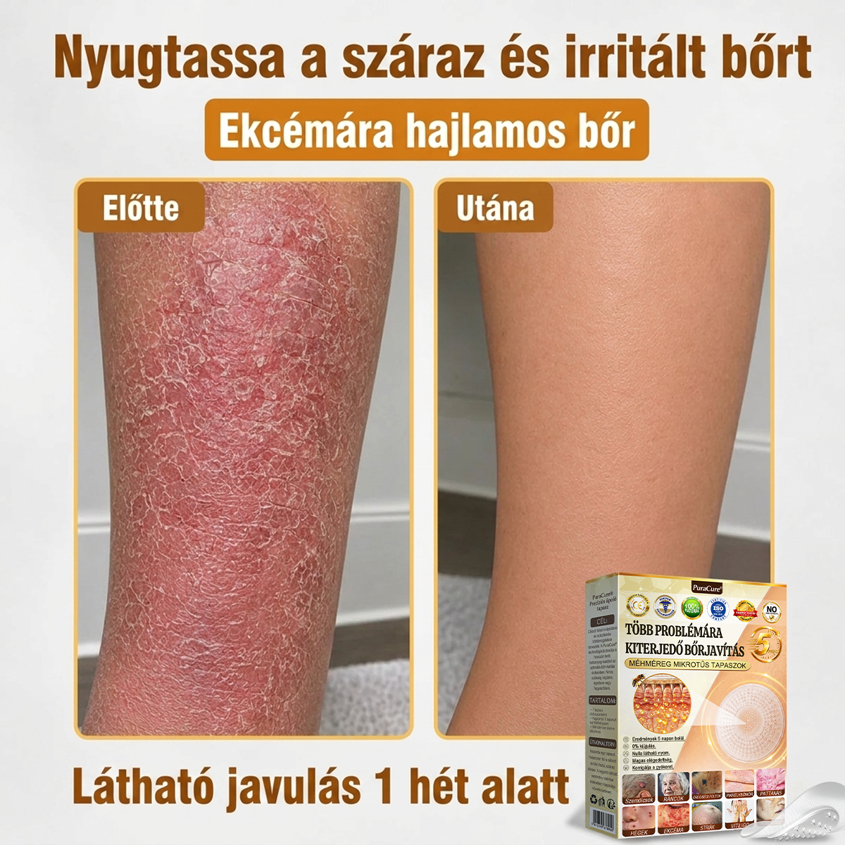 🐝PuraCure® TÖBBFÉLE BŐRPROBLÉMÁRA HATÓ MÉHMÉREG MIKROTŰS BŐRREGENERÁLÓ TAPASZOK