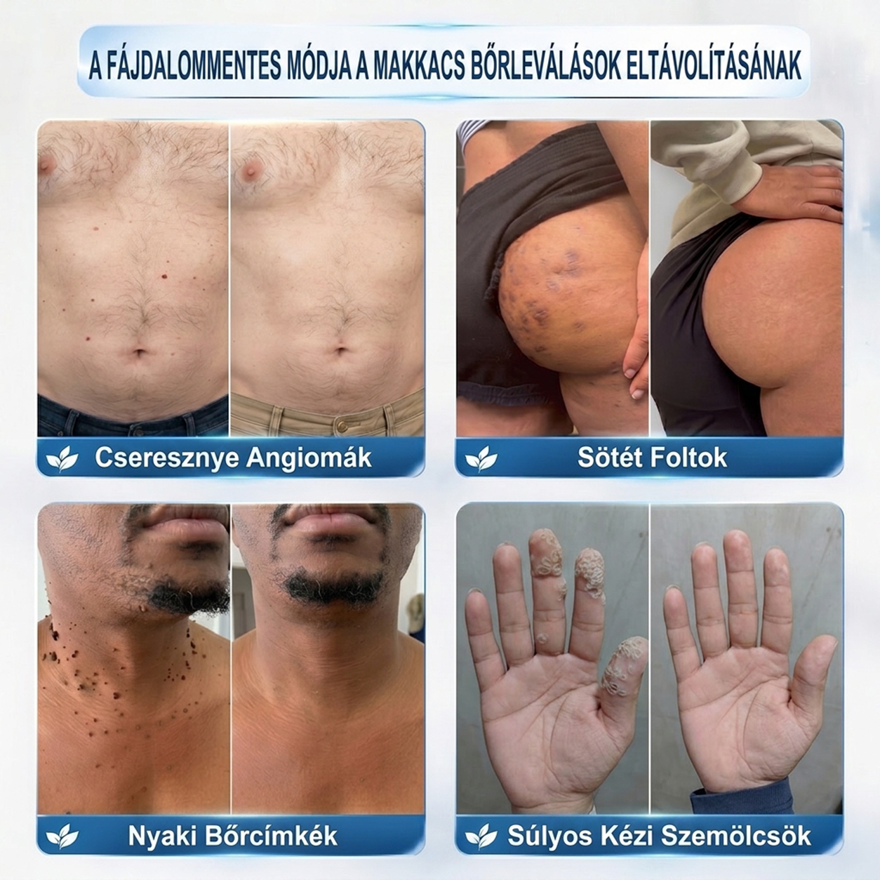 🌷𝐏𝐮𝐫𝐚𝐂𝐮𝐫𝐞® 𝐌𝐈𝐊𝐑𝐎𝐓Ű𝐒 𝐁Ő𝐑𝐊𝐈𝐍Ö𝐕É𝐒-𝐄𝐋𝐓Á𝐕𝐎𝐋Í𝐓Ó 𝐓𝐀𝐏𝐀𝐒𝐙𝐎𝐊 - ✅𝟕 𝐍𝐀𝐏𝐎𝐒 𝐂É𝐋𝐙𝐎𝐓𝐓 𝐄𝐋𝐓Á𝐕𝐎𝐋Í𝐓Á𝐒 𝐁Ő𝐑𝐍𝐘Ú𝐋𝐕Á𝐍𝐘𝐎𝐊, 𝐒𝐙𝐄𝐌Ö𝐋𝐂𝐒Ö𝐊 É𝐒 𝐊𝐈𝐄𝐌𝐄𝐋𝐊𝐄𝐃Ő 𝐁Ő𝐑𝐇𝐈𝐁Á𝐊 𝐄𝐋𝐋𝐄𝐍