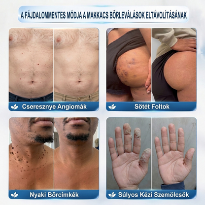 🌷𝐏𝐮𝐫𝐚𝐂𝐮𝐫𝐞® 𝐌𝐈𝐊𝐑𝐎𝐓Ű𝐒 𝐁Ő𝐑𝐊𝐈𝐍Ö𝐕É𝐒-𝐄𝐋𝐓Á𝐕𝐎𝐋Í𝐓Ó 𝐓𝐀𝐏𝐀𝐒𝐙𝐎𝐊 - ✅𝟕 𝐍𝐀𝐏𝐎𝐒 𝐂É𝐋𝐙𝐎𝐓𝐓 𝐄𝐋𝐓Á𝐕𝐎𝐋Í𝐓Á𝐒 𝐁Ő𝐑𝐍𝐘Ú𝐋𝐕Á𝐍𝐘𝐎𝐊, 𝐒𝐙𝐄𝐌Ö𝐋𝐂𝐒Ö𝐊 É𝐒 𝐊𝐈𝐄𝐌𝐄𝐋𝐊𝐄𝐃Ő 𝐁Ő𝐑𝐇𝐈𝐁Á𝐊 𝐄𝐋𝐋𝐄𝐍