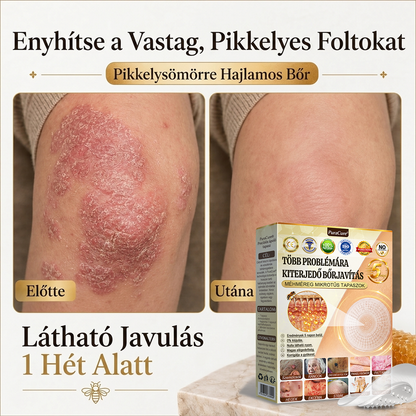 🐝PuraCure® TÖBBFÉLE BŐRPROBLÉMÁRA HATÓ MÉHMÉREG MIKROTŰS BŐRREGENERÁLÓ TAPASZOK