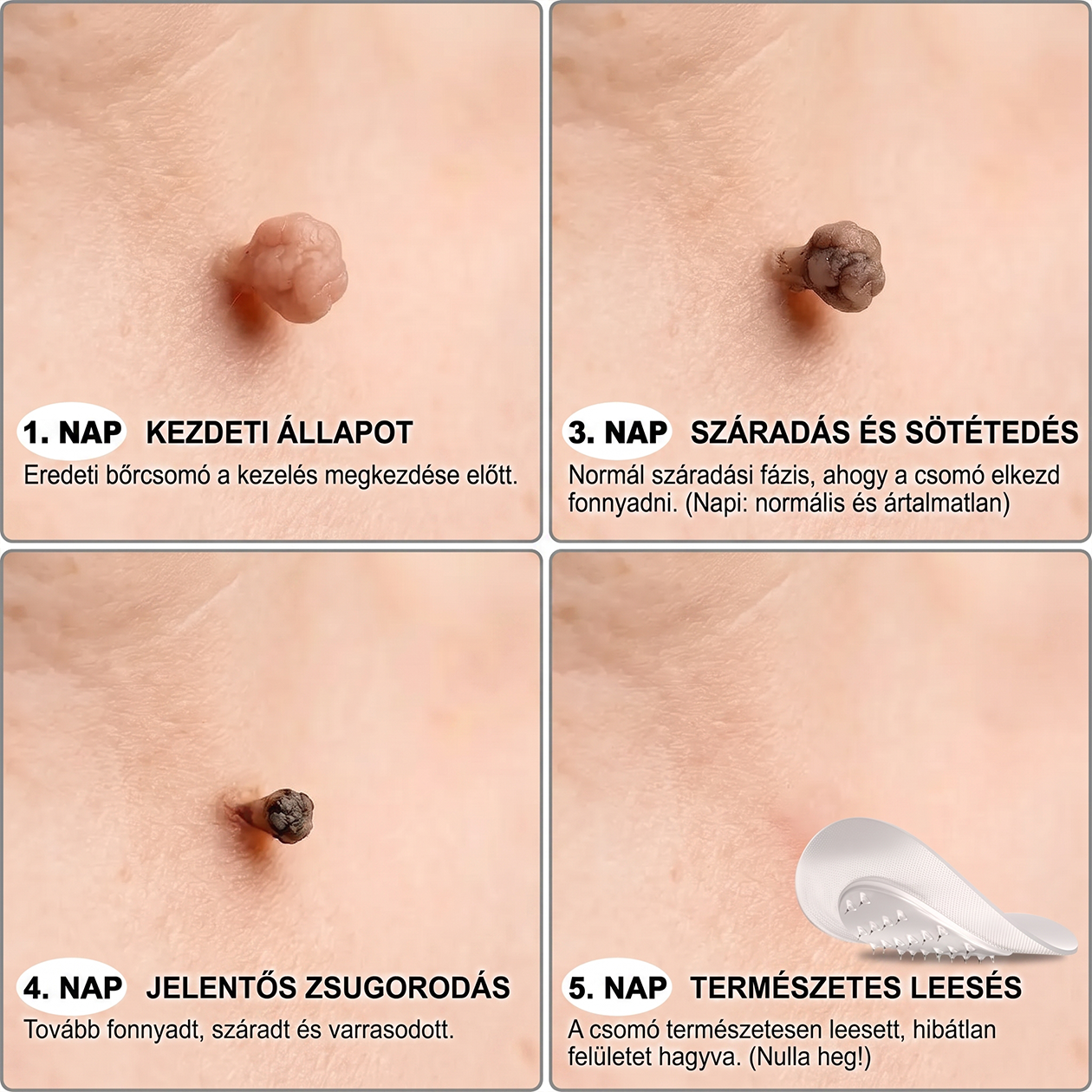 🌷𝐏𝐮𝐫𝐚𝐂𝐮𝐫𝐞® 𝐌𝐈𝐊𝐑𝐎𝐓Ű𝐒 𝐁Ő𝐑𝐊𝐈𝐍Ö𝐕É𝐒-𝐄𝐋𝐓Á𝐕𝐎𝐋Í𝐓Ó 𝐓𝐀𝐏𝐀𝐒𝐙𝐎𝐊 - ✅𝟕 𝐍𝐀𝐏𝐎𝐒 𝐂É𝐋𝐙𝐎𝐓𝐓 𝐄𝐋𝐓Á𝐕𝐎𝐋Í𝐓Á𝐒 𝐁Ő𝐑𝐍𝐘Ú𝐋𝐕Á𝐍𝐘𝐎𝐊, 𝐒𝐙𝐄𝐌Ö𝐋𝐂𝐒Ö𝐊 É𝐒 𝐊𝐈𝐄𝐌𝐄𝐋𝐊𝐄𝐃Ő 𝐁Ő𝐑𝐇𝐈𝐁Á𝐊 𝐄𝐋𝐋𝐄𝐍