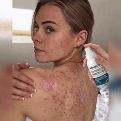 💧💧Medistart® Speciális Bőrápoló Krém Pikkelysömörös Bőrre - ✅Dermatológiailag tesztelt