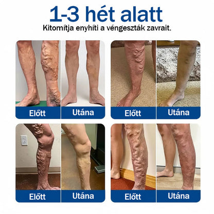 💙Medistart® Visszérápoló Mikrotűs Gondozó Tapasz ✅ Azonnali Megkönnyebbülés, Hosszú Távú Eredmények
