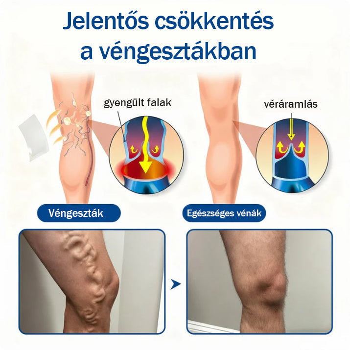💙Medistart® Visszérápoló Mikrotűs Gondozó Tapasz ✅ Azonnali Megkönnyebbülés, Hosszú Távú Eredmények
